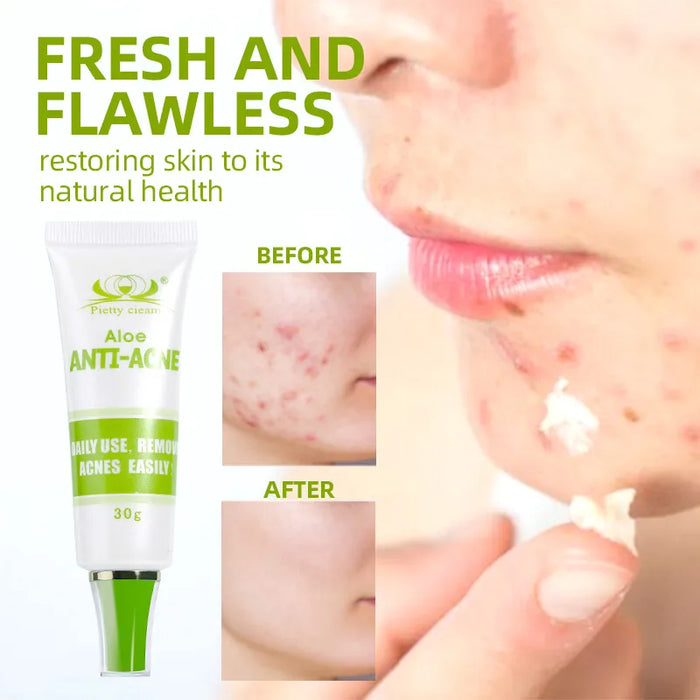 30g Acne Cream soothes