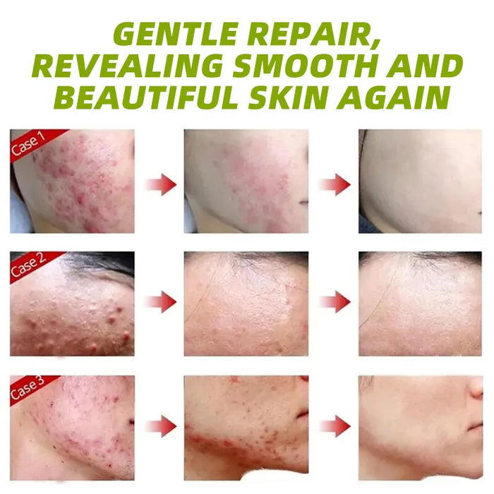 30g Acne Cream soothes