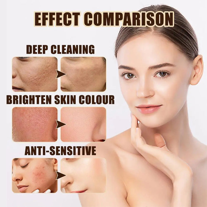30g Acne Cream soothes